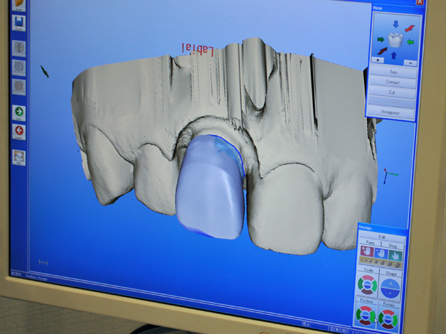 セレックは歯科治療の3Dプリンターです